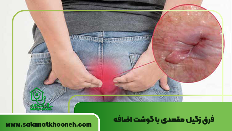 فرق زگیل مقعدی با گوشت اضافه