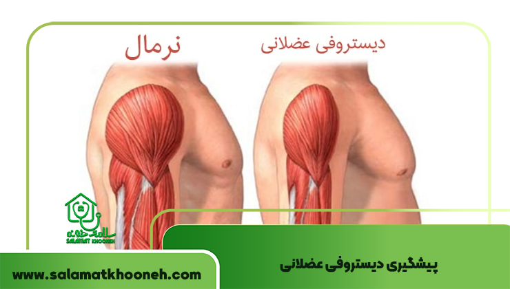 پیشگیری دیستروفی عضلانی