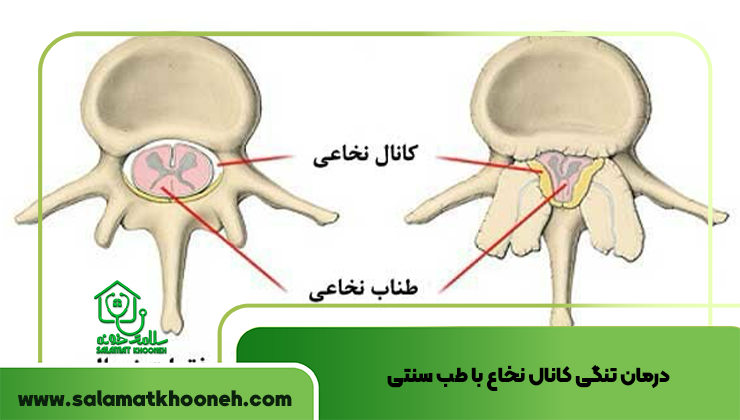درمان تنگی کانال نخاع با طب سنتی