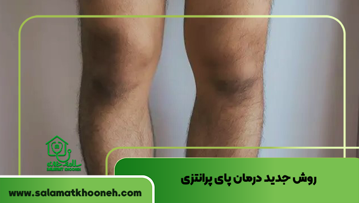 روش جدید درمان پای پرانتزی