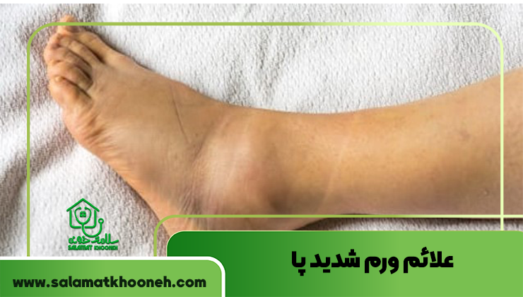 علائم ورم شدید پا