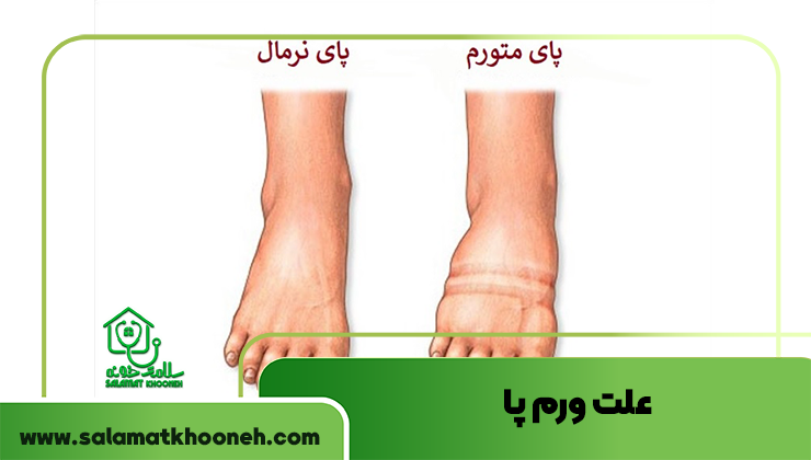 علت ورم پا