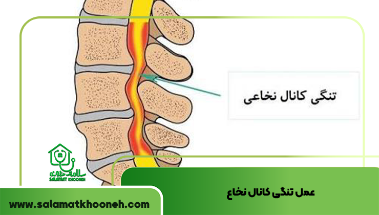 عمل تنگی کانال نخاع