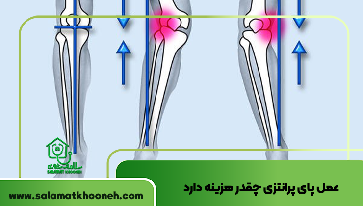 عمل پای پرانتزی چقدر هزینه دارد