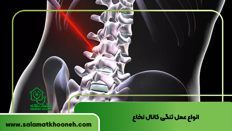 مراحل انجام عمل تنگی کانال نخاع تجربه عمل تنگی کانال نخاع