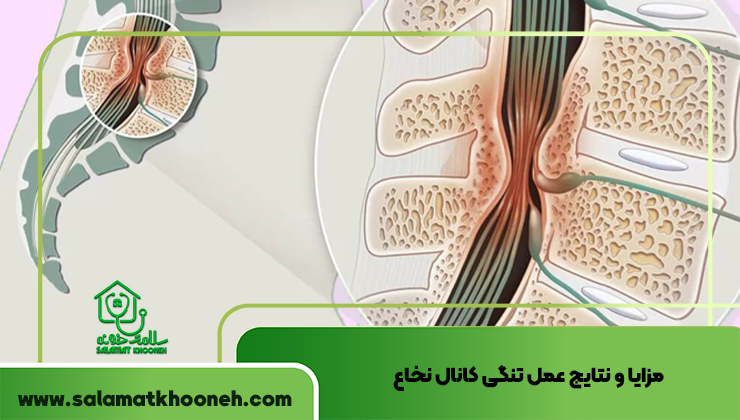 مزایا و نتایج عمل تنگی کانال نخاع نظرات عمل تنگی کانال نخاع کمر