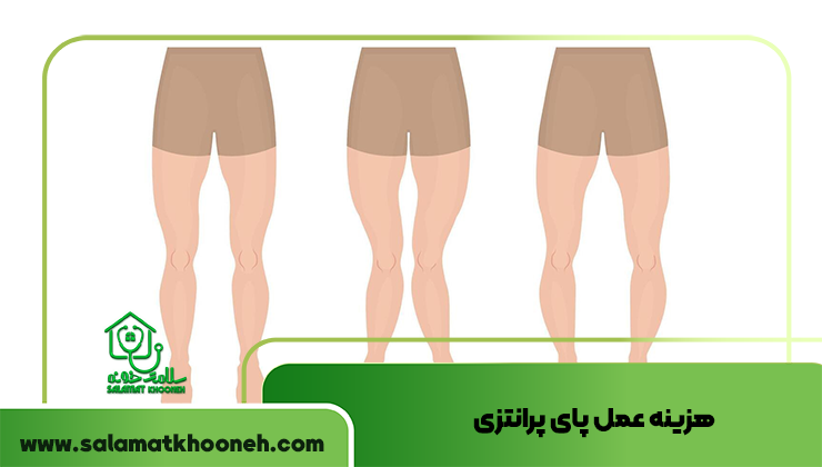 هزینه عمل پای پرانتزی، هر آنچه باید بدانید