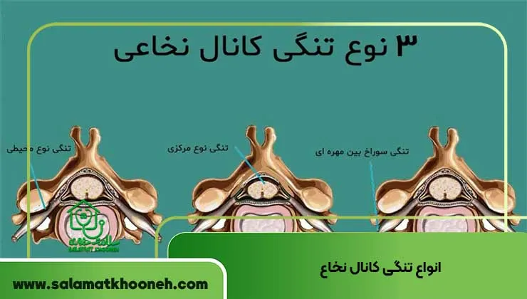 انواع تنگی کانال نخاع
