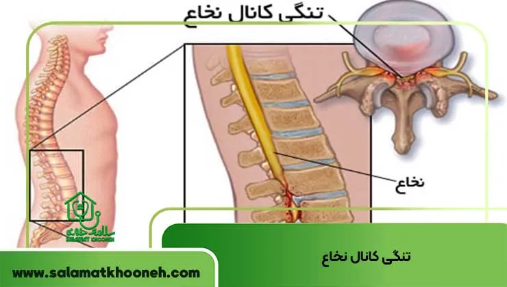 تنگی کانال نخاع
