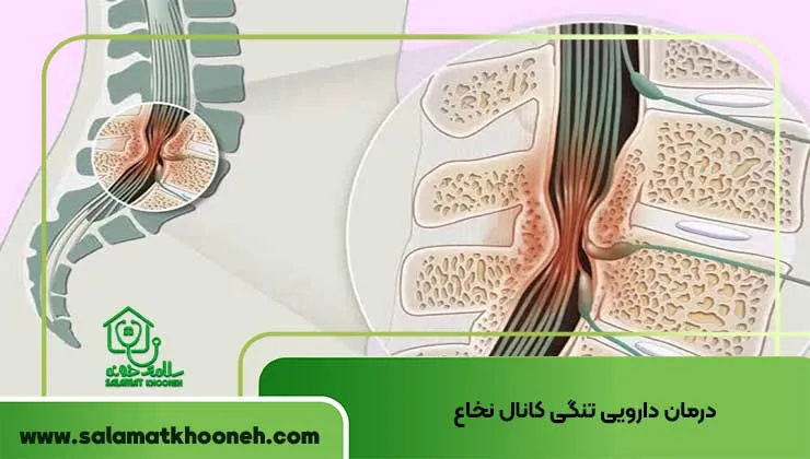 درمان دارویی تنگی کانال نخاع