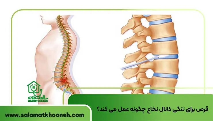 قرص برای تنگی کانال نخاع چگونه عمل می کند؟