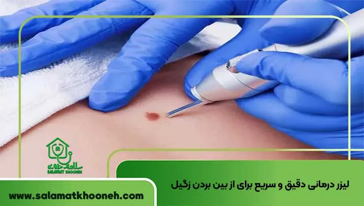 لیزر درمانی دقیق و سریع برای از بین بردن زگیل
