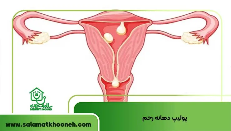 پولیپ دهانه رحم از دلایل شایع خونریزی بعد از رابطه جنسی