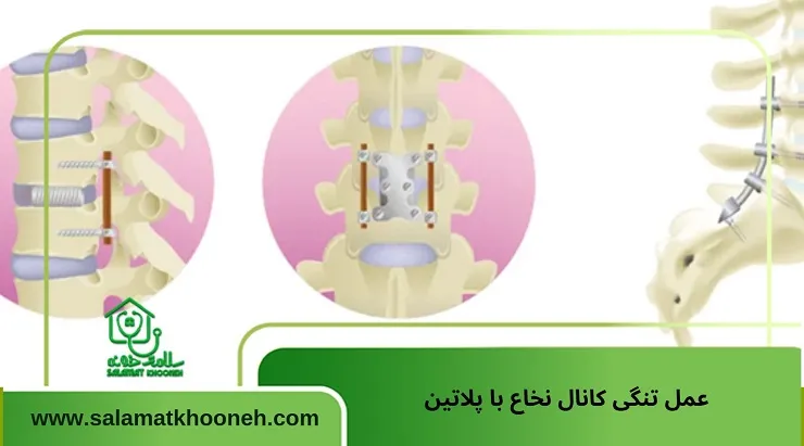 عمل تنگی کانال نخاع با پلاتین