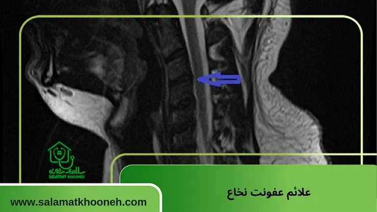 علائم عفونت نخاع