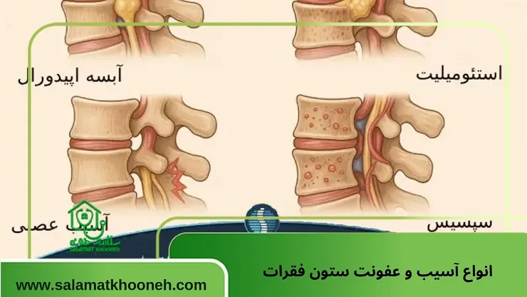 عفونت نخاع چیست؟