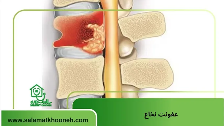 عفونت نخاع چیست؟ علائم هشدار، علت‌ها و روش‌های درمان فوری