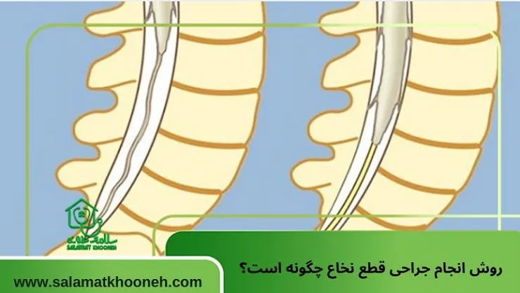 عکس قطع نخاع و روش انجام جراحی قطع نخاع چگونه است؟