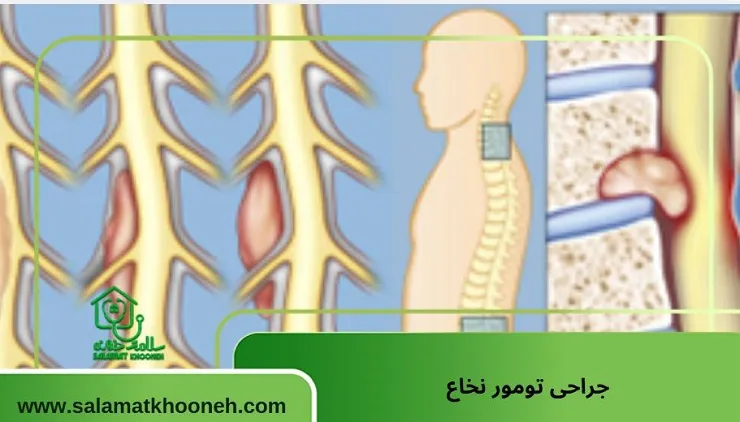 جراحی تومور نخاع: بررسی عوارض، موفقیت و مراقبت‌ها