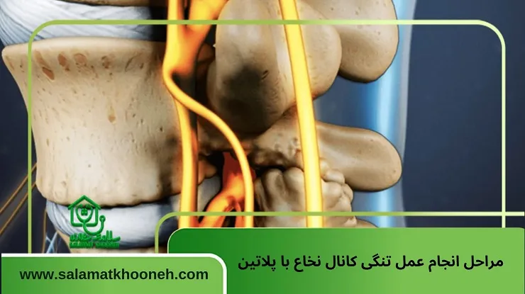 مراحل انجام عمل تنگی کانال نخاع با پلاتین