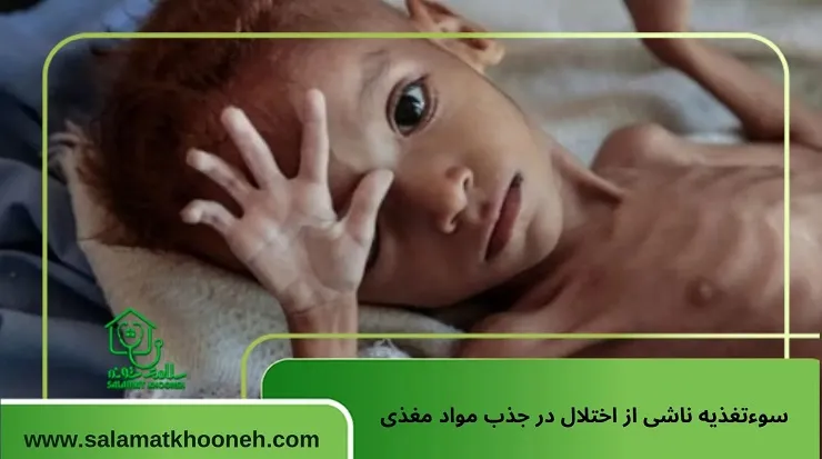 سوءتغذیه ناشی از اختلال در جذب مواد مغذی
