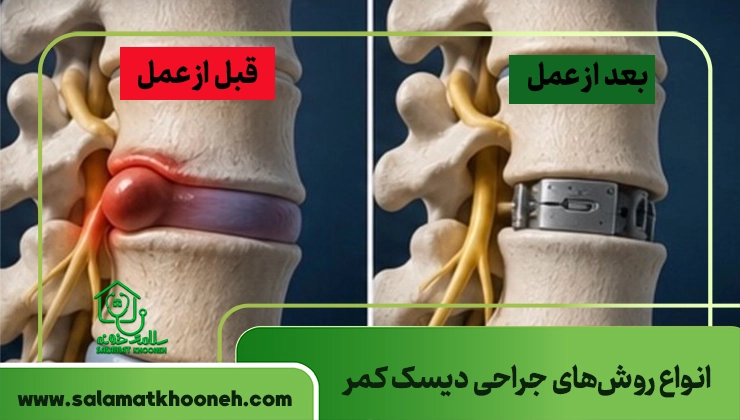 انواع روش های جراحی دیسک کمر