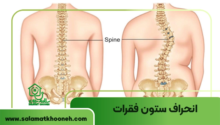 ورزش برای انحراف ستون فقرات