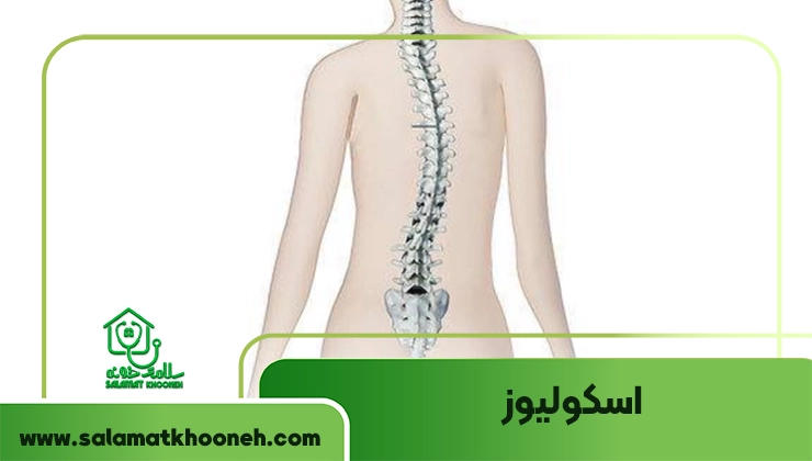اسکولیوز