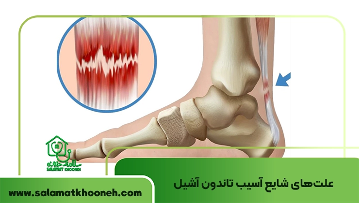 علل آسیب تاندون آشیل