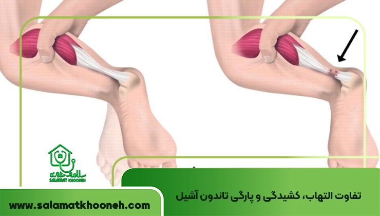 آسیب تاندون آشیل