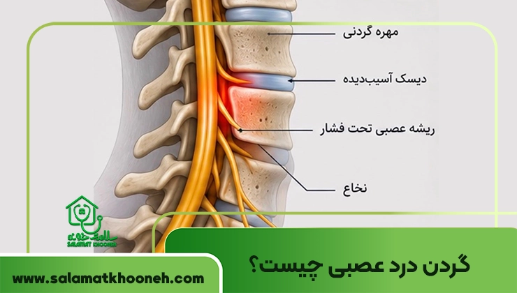 گردن درد عصبی
