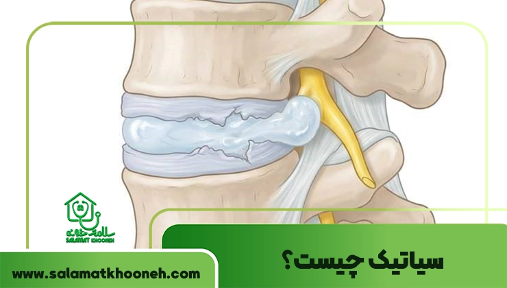 سیاتیک چیست؟