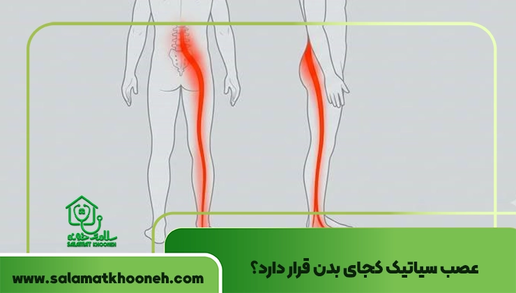 سیاتیک