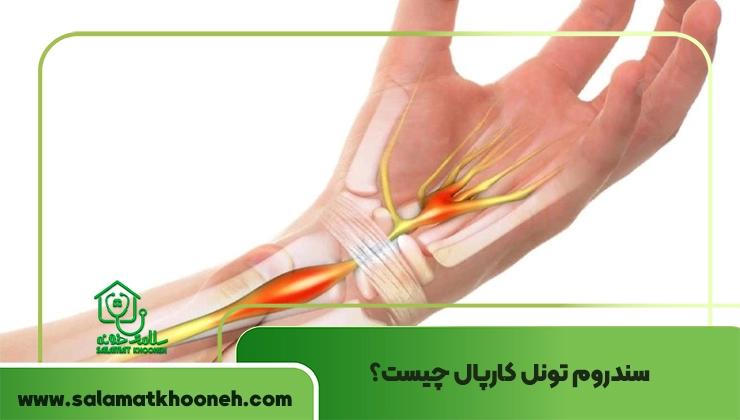 سندروم تونل کارپال