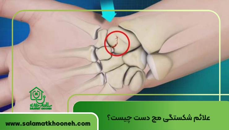 علائم شکستگی مچ دست