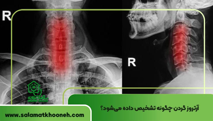 تشخیص آرتروز گردن