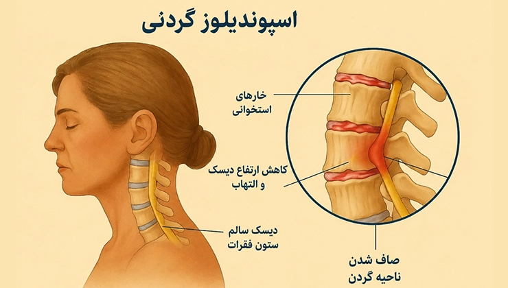 اسپوندیلوز گردن