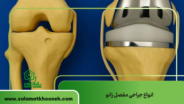 انواع جراحی مفصل زانو