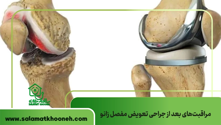 مراقبت‌های بعد از جراحی تعویض مفصل زانو